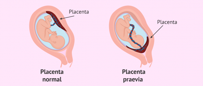 Imagen: Placenta-praevia
