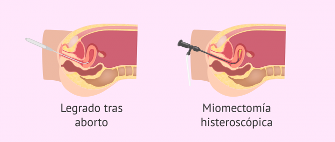 La cirugía abdominal puede causar el síndrome de Asherman