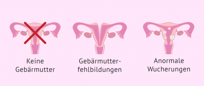 Imagen: Probleme schwanger zu werden aufgrund Gebärmutterkrankheiten