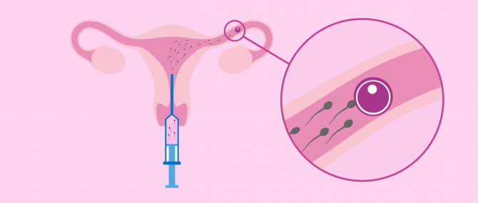 ¿Qué es la inseminación artificial?