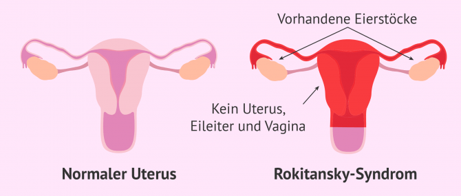 Imagen: Fehlende Vagina, Gebärmutter und Eileiter