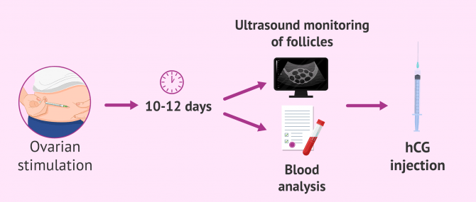 Imagen: Scheduling the ovum pick-up