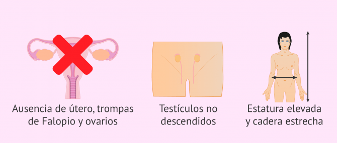 Imagen: Síntomas y características del síndrome de Morris