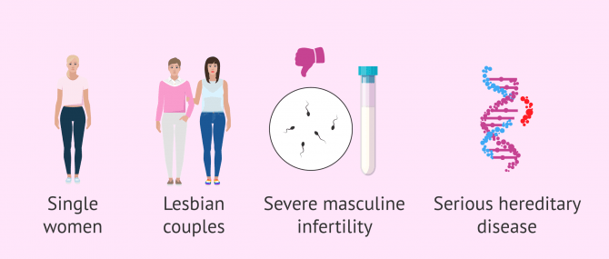 Imagen: Situation in which sperm donation is needed