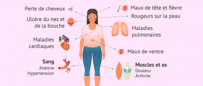 Imagen: Symptômes du lupus