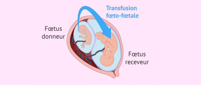 Imagen: Syndrome de transfusion de foetus à foetus
