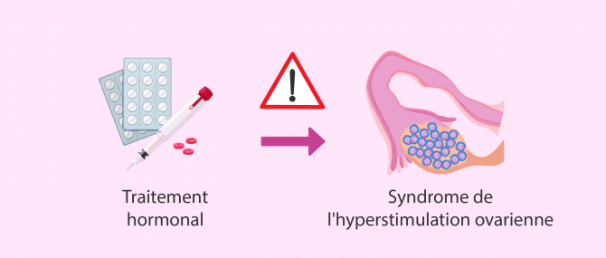 Imagen: syndrome hyperstimulation ovarienne