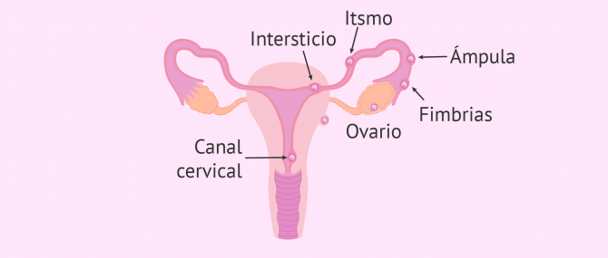 Imagen: Lugares de implantación del embrión en un embarazo ectópico