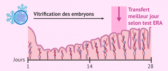 Transfert embryonnaire après un test ERA