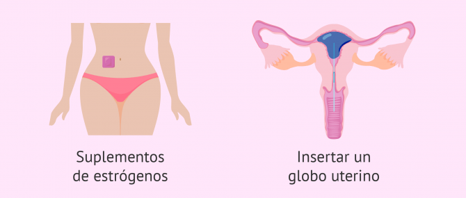Tratamiento del síndrome de Asherman