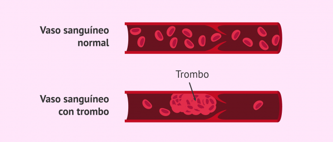 Imagen: Trombofilia y embarazo