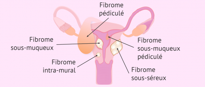 Types de myomatose utérine