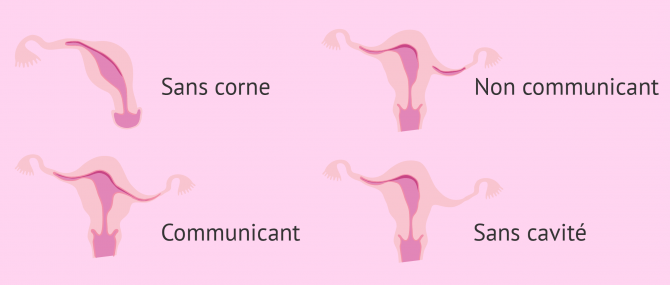 Types d'utérus unicorne