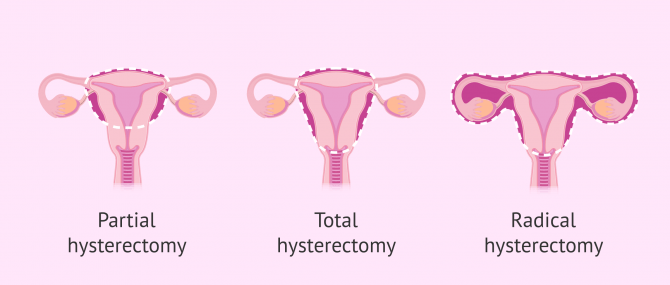 Imagen: Types of Hysterectomy