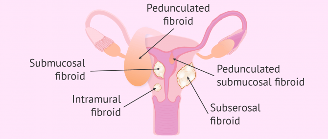 Types of uterine fibroids