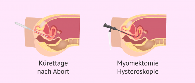Imagen: Mögliche Ursachen des Asherman-Syndroms