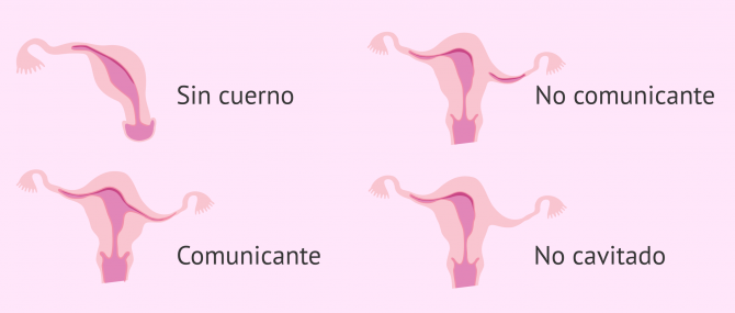 Imagen: Útero unicorne