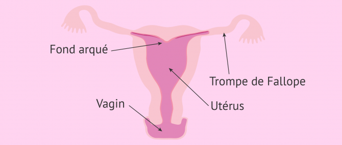 Utérus à fond arqué ou utérus arcuatus