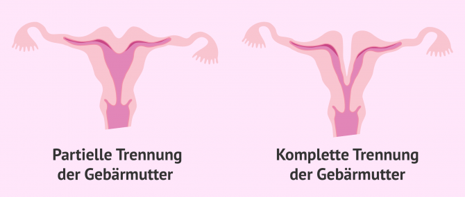 Imagen: Uterus bicornis