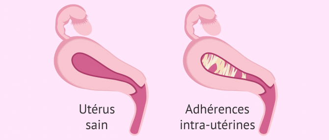 Utérus sain et utérus atteint du syndrome d'Asherman