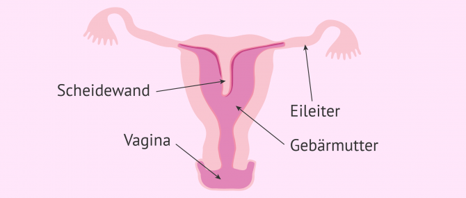 Imagen: Uterus septus