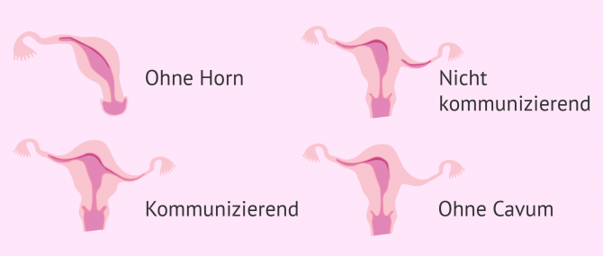 Imagen: Uterus unicornis